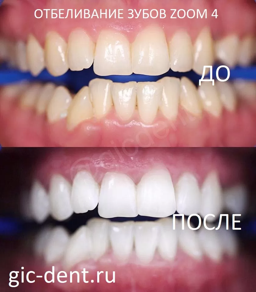 Отбеливание зубов zoom 4 в немецком имплантологическом центре